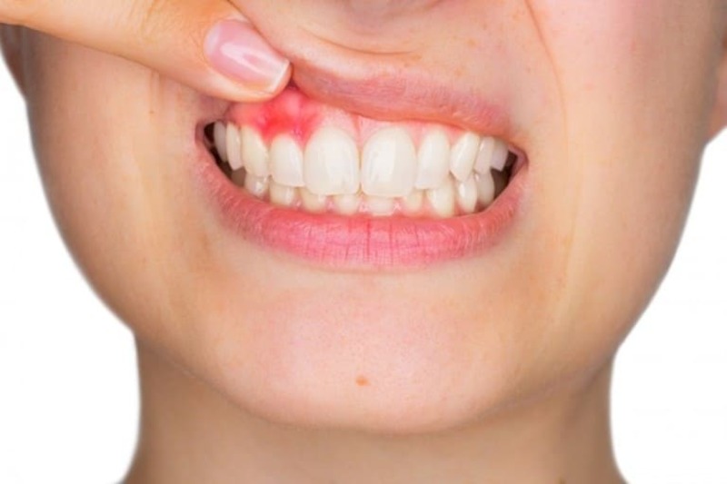 Nướu răng nổi mụn gây khó khăn trong ăn uống và giao tiếp