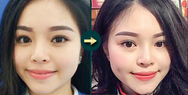 Xác định và đánh dấu vị trí trước khi tạo má lúm