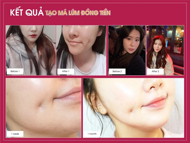 Kết quả sau khi tạo má lúm tại bệnh viện thẩm mỹ thuộc SeoulSpa.Vn