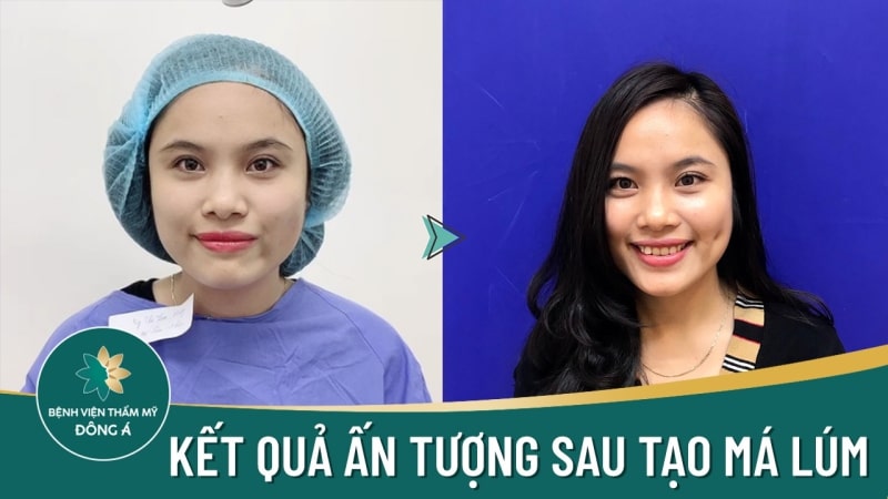 Tạo má lúm tại bệnh viện thẩm mỹ Đông Á