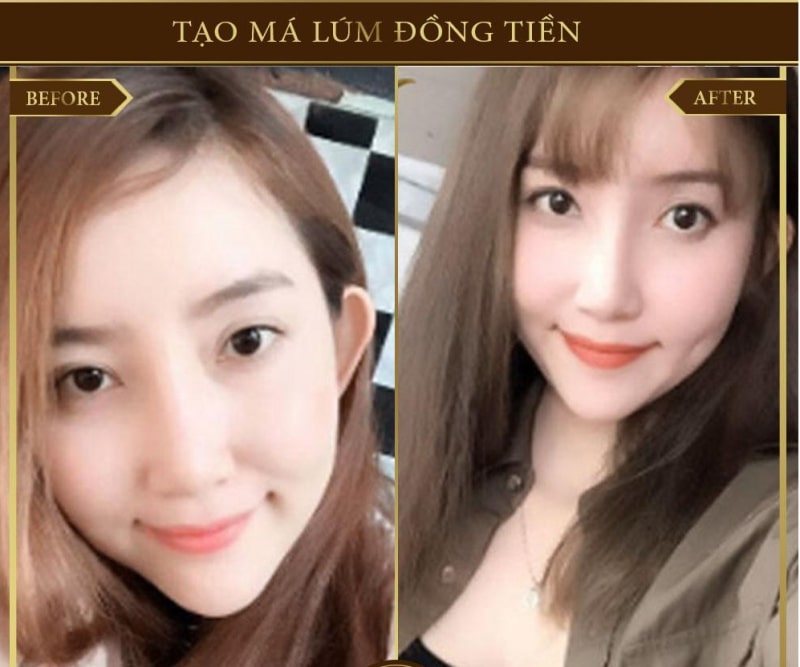 Tạo má lúm tại thẩm mỹ viện Dr.Hải Lê