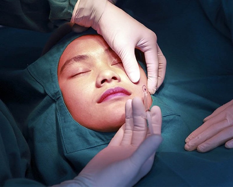 Tạo má lúm tại thẩm mỹ viện Xuân Hương