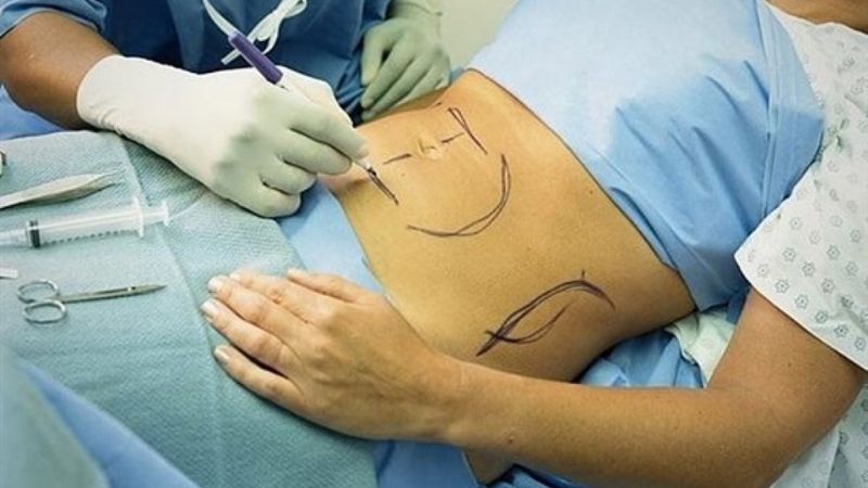 Top 20+ Giảm Béo Contri Lipo Có Hiệu Quả Không Tiêm tan mỡ bụng là gì? Có duy trì hiệu quả lâu dài? 23 Những Điều Bạn Cần Biết Về Tiêm Mỡ Bụng