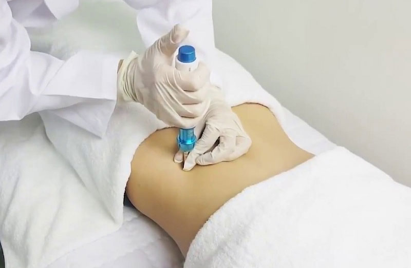 Top 20+ Giảm Béo Contri Lipo Có Hiệu Quả Không Tiêm tan mỡ bụng là gì? Có duy trì hiệu quả lâu dài? 25 Kim lăn tan mỡ bụng sẽ có hiệu quả trong vòng 1 năm