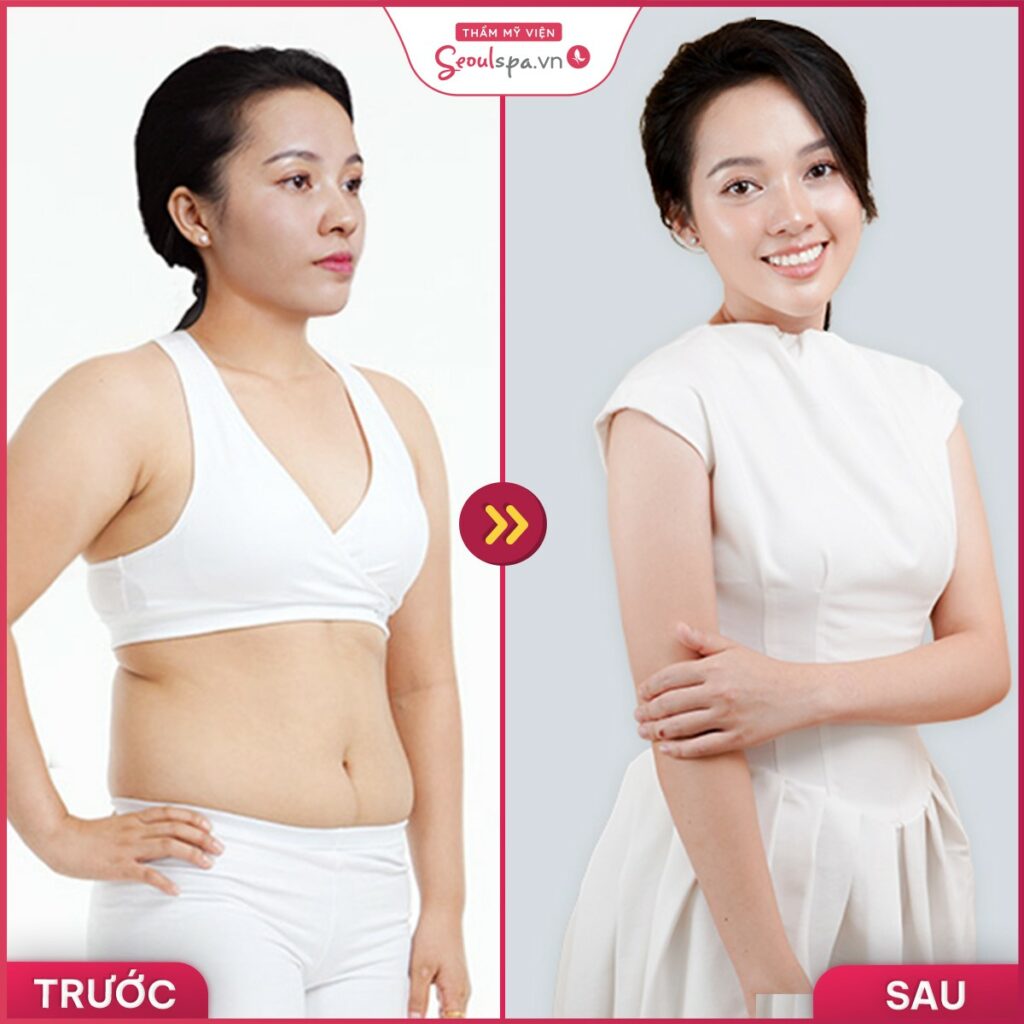 Top 20+ Giảm Béo Contri Lipo Có Hiệu Quả Không Tiêm tan mỡ bụng là gì? Có duy trì hiệu quả lâu dài? 29 E sonic – kỹ thuật giảm béo hiệu quả được nhiều nước tiên tiến áp dụng