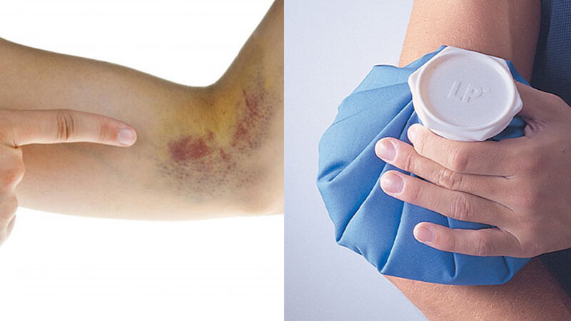 Các vết bầm tím trên da không nghiệm trọng có thể điều trị dễ dàng tại nhà
