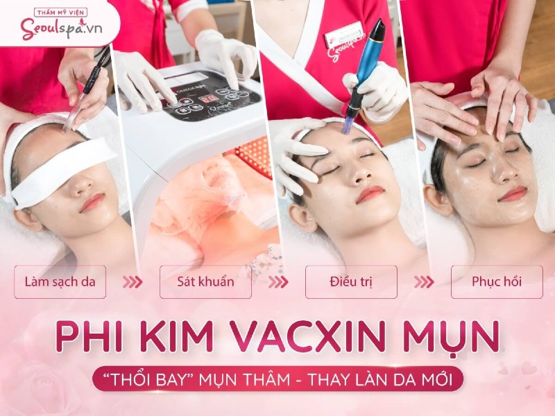 Liệu trình trị mụn bằng công nghệ phi kim vaccin mụn