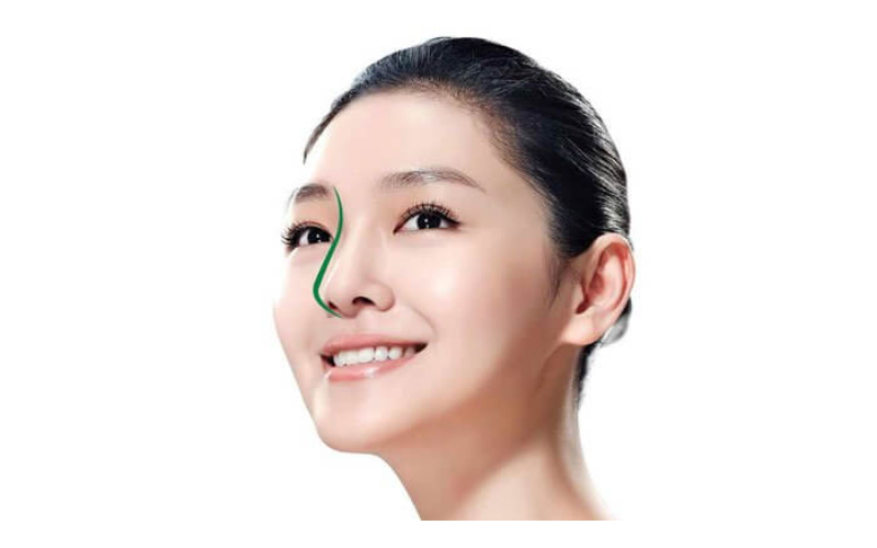 Top 20+ Nâng Mũi Bán Cấu Trúc Giá Bao Nhiêu Nâng mũi bán cấu trúc là gì? Có nên nâng mũi bán cấu trúc không? 19 Cần thăm khám và kiểm tra sức khỏe trước khi nâng mũi bán cấu trúc
