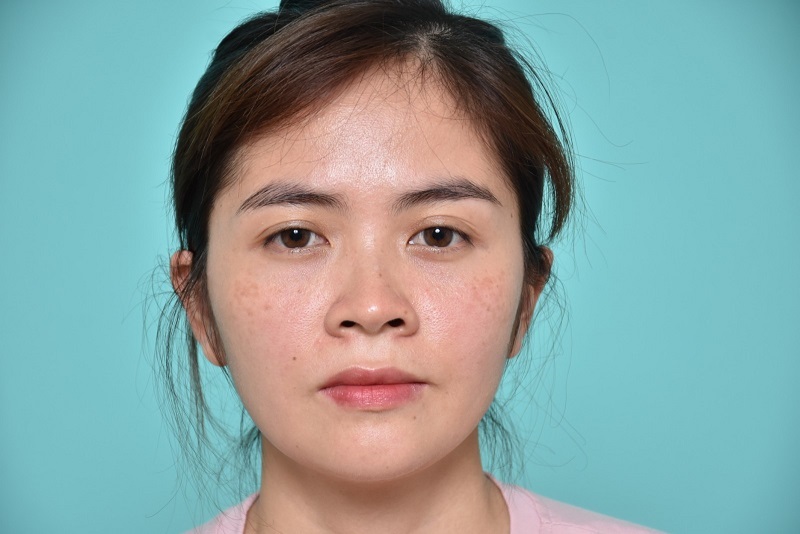 Mỗi người sẽ có khuyết điểm mũi khác nhau nên giá nâng mũi cũng sẽ phụ thuộc