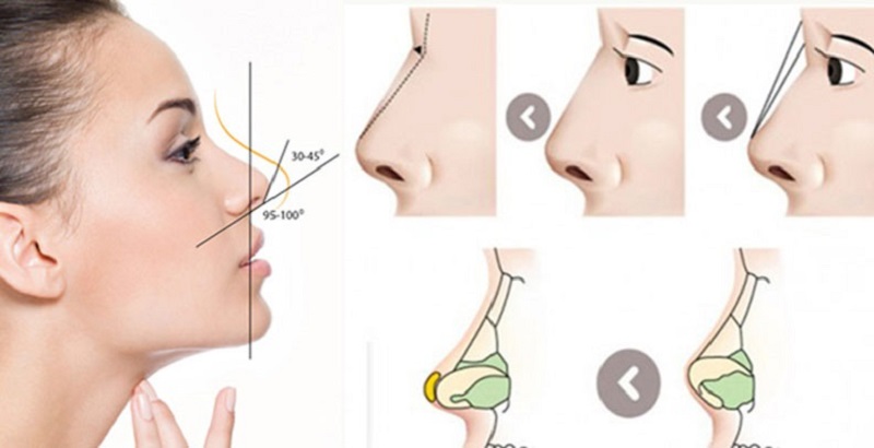 Nâng mũi cấu trúc có giá cao nhất trong các phương pháp
