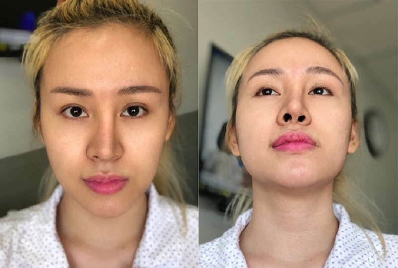 Vì ham nâng mũi giá rẻ, mũi cô gái bị hỏng, lệch sóng gây mất thẩm mỹ gương mặt