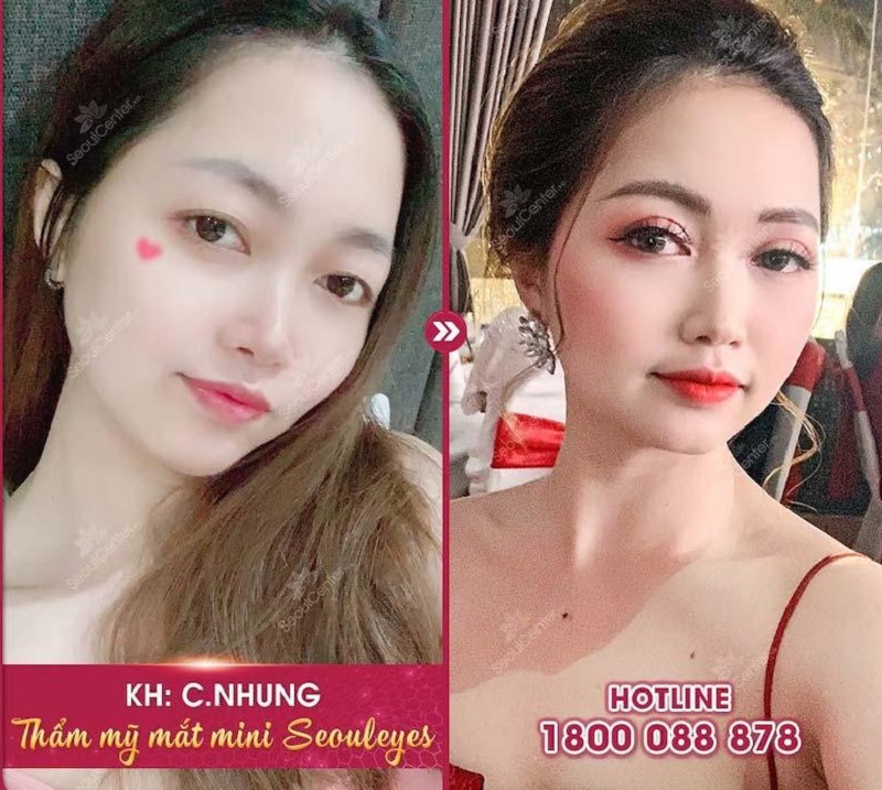 Nhiều chị em lột xác sau khi cắt mí