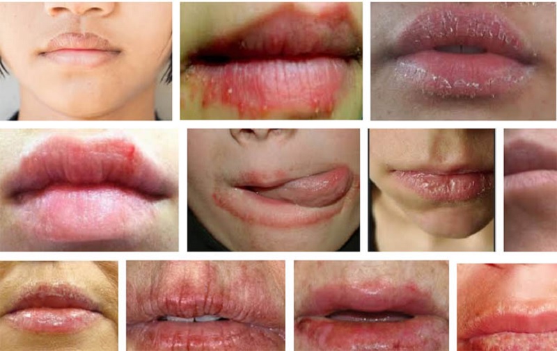 Chàm môi khiến cho môi của bạn bị khô, bong tróc, mất thẩm mỹ