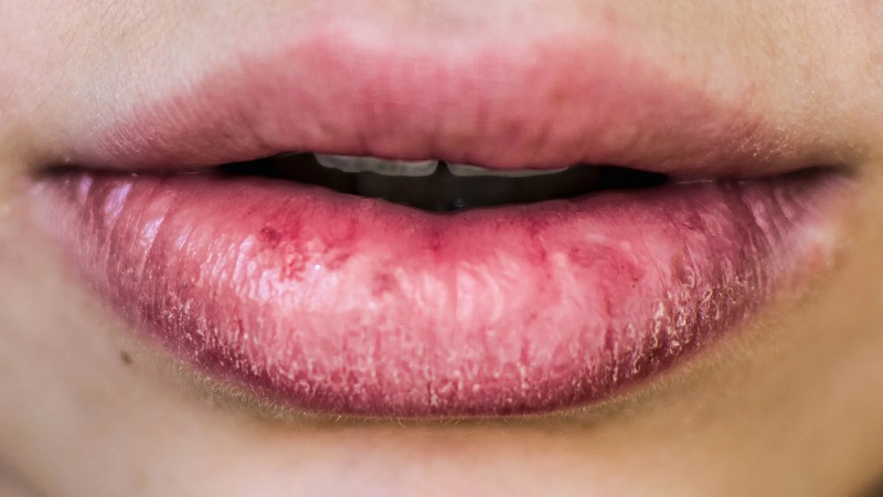 Một số người bị chàm môi do cơ địa hoặc di truyền