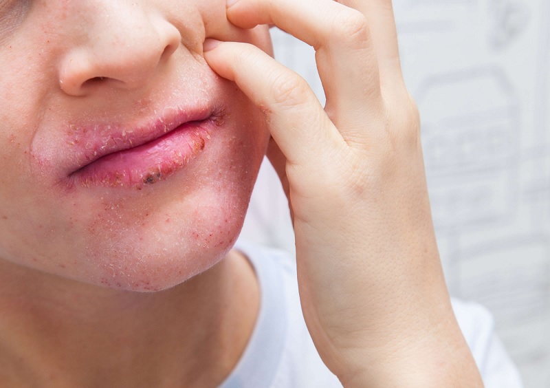Với tình trạng chàm môi nặng gây nhiều triệu chứng khó chịu, bạn nên đến bệnh viện