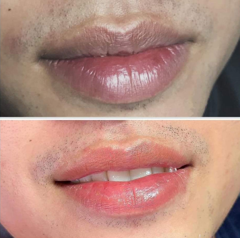 Khử môi thâm có mức giá chênh lệch sở nhiều cơ sở làm đẹp