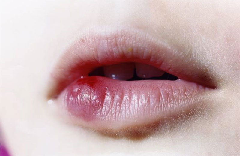 Môi có thể bị sưng phù, viêm mủ nếu khử thâm ở địa điểm kém chất lượng