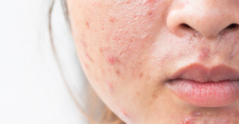 Làn da bị mụn do nhiễm corticoid không phù hợp với phương pháp lăn kim