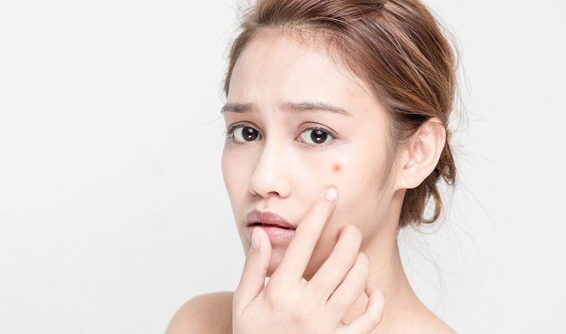 Có nhiều lý do bên trong lẫn ngoài có thể gây ra mụn viêm không nhân
