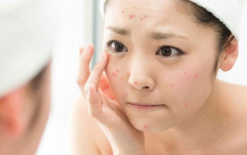 Làn da của chị em sẽ nổi nhiều mụn hơn khi sử dụng nước tẩy trang giả
