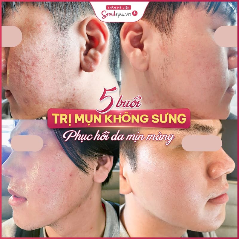 Top 20+ Thẩm Mỹ Viện Kim Chi Bình Dương TOP 10 Spa - Thẩm mỹ viện phái đẹp nên biết tại Bình Dương 63 Dịch vụ trị mụn ở SeoulSpa.Vn Bình Dương cho hiệu quả vượt trội sau liệu trình đầu điều trị