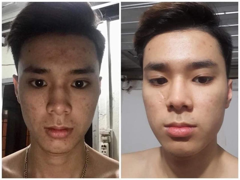 Làn da sạch mụn sau khi điều trị tại Bệnh viện da liễu Hồ Chí Minh