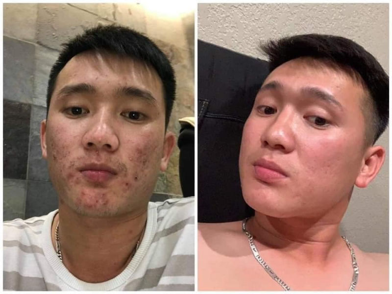 Kết quả trị mụn và chăm sóc da chuyên sâu tại Evie Clinic tại Hồ Chí Minh