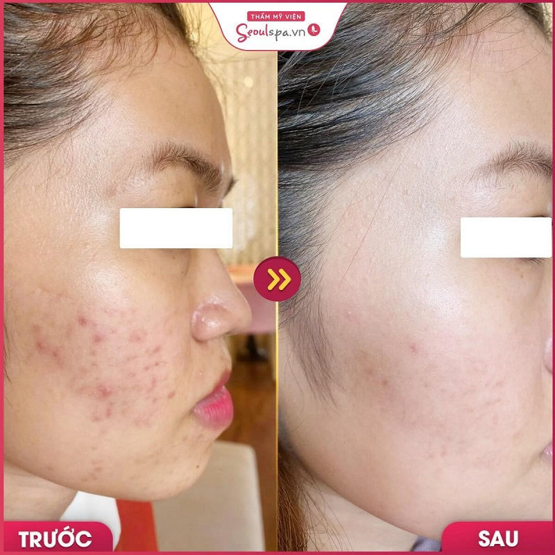Da sáng mịn và trơn láng sau khi trị mụn bằng huyết thanh tảo biển