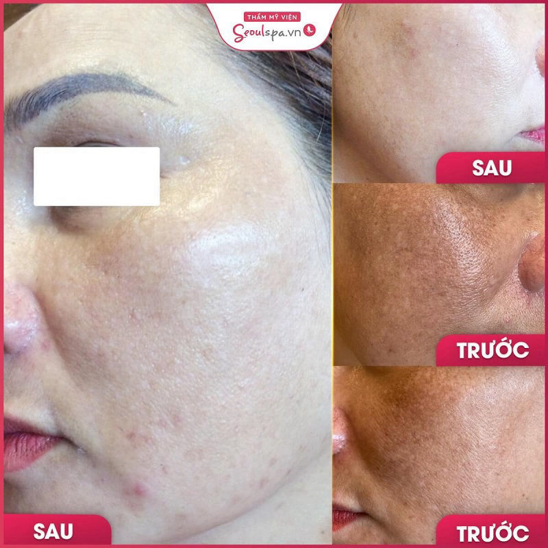 Kết quả điều trị nám bằng ánh sáng Elight tại Seoul Spa