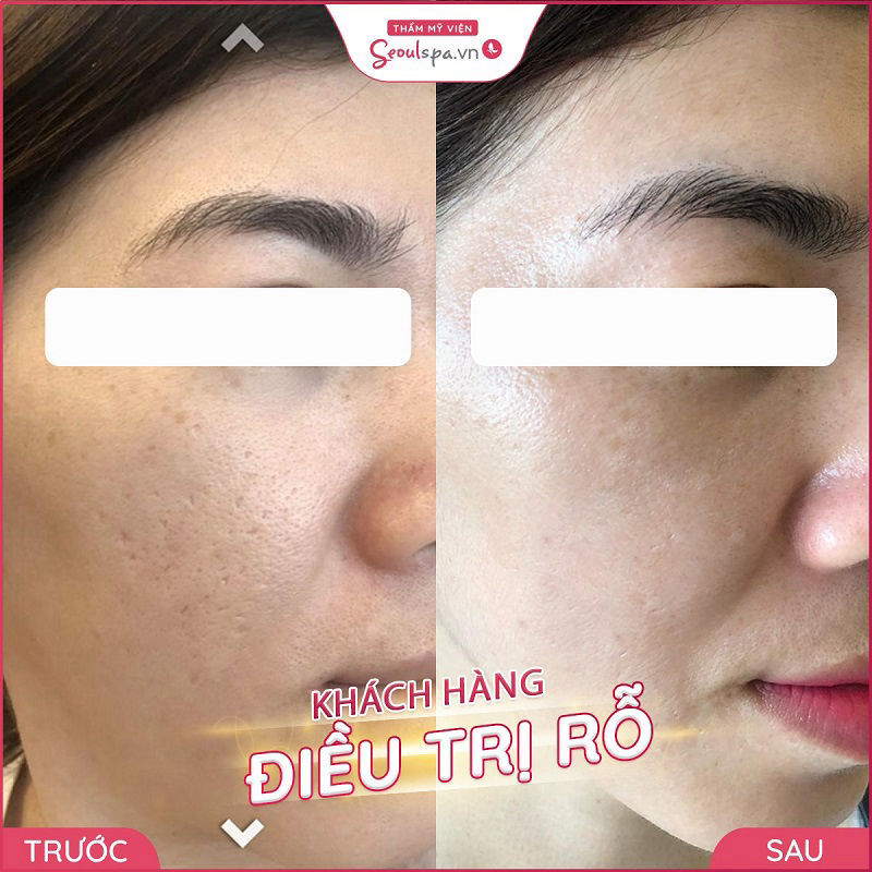 Công nghệ PRP 4.0 trị sẹo rỗ nhanh chóng và chính xác