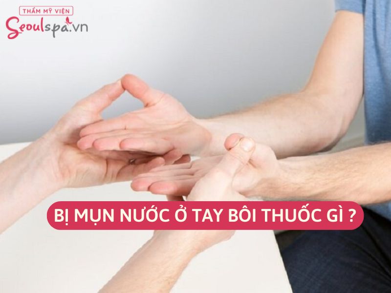 Bị mụn nước ở tay bôi thuốc gì trị hiệu quả?