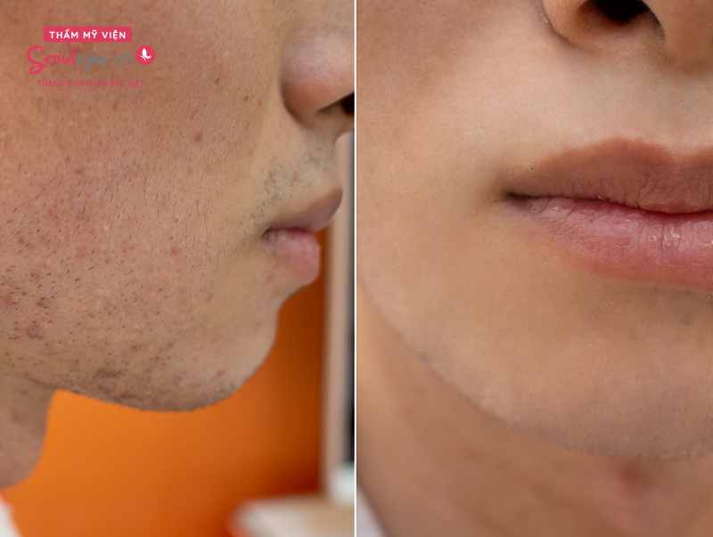 Triệt râu vĩnh viễn cho nam giới giá bao nhiêu tiền? Cập nhật mới