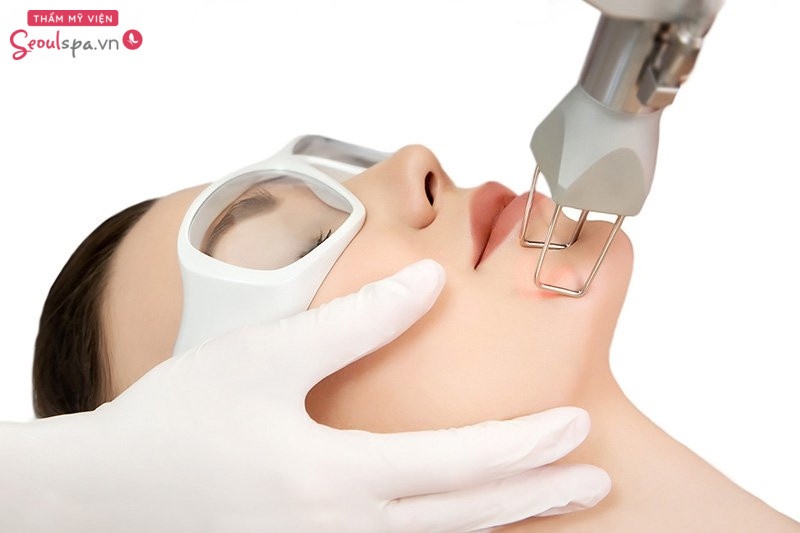 Công nghệ se khít lỗ chân lông Laser Fractional CO2