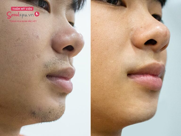 Triệt râu vĩnh viễn cho nam giới giá bao nhiêu tiền?