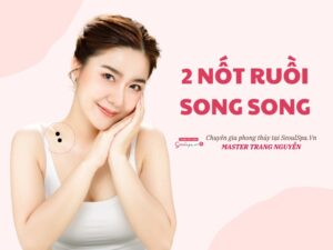2 nốt ruồi song song