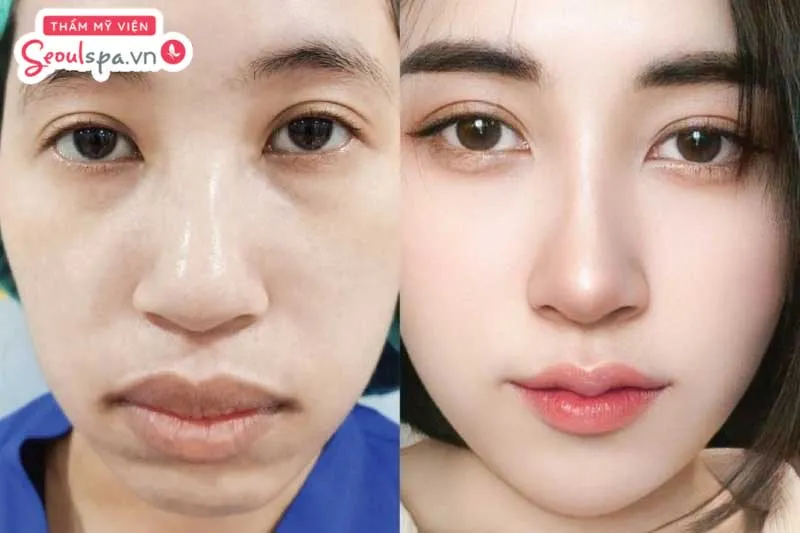 Thực hiện phẫu thuật chỉnh hình môi sẽ giúp loại bỏ cấu trúc mô mềm ở môi trên và điều chỉnh cân đối với môi dưới
