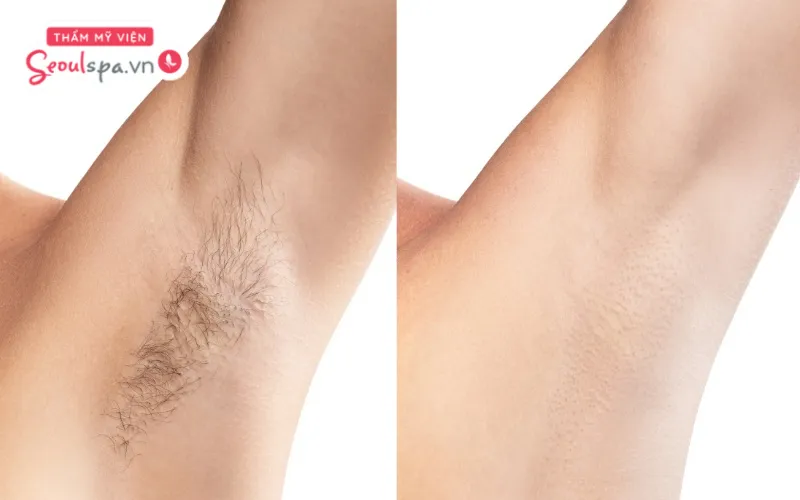 Lông nách có thể tự rụng ở giai đoạn thoái hóa nhưng lông mới sẽ nhanh chóng mọc lại sau khi rụng