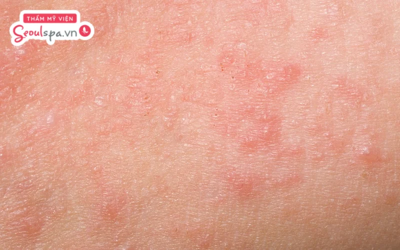 Nổi mẩn đỏ sau khi triệt lông chân là tình trạng thường gặp và có thể xuất phát bởi cơ địa quá nhạy cảm
