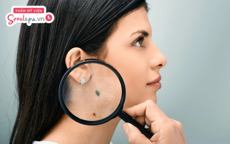 Nốt ruồi màu xanh là đặc điểm nốt ruồi có bề mặt hơi sần nhẹ và có màu xám xanh hoặc xanh sẫm
