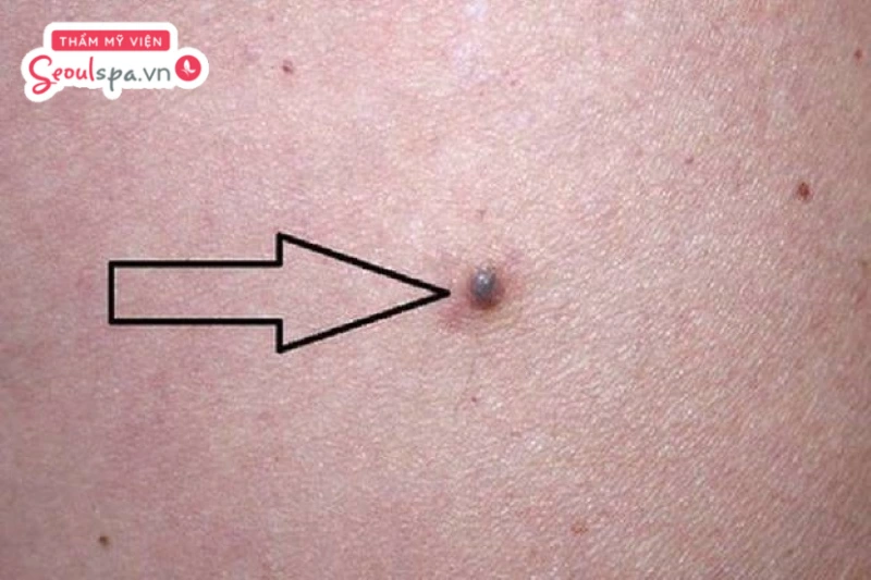 Nốt ruồi xanh có nguy hiểm không còn tùy thuộc vào đặc điểm của nốt ruồi lành tính hay ác tính