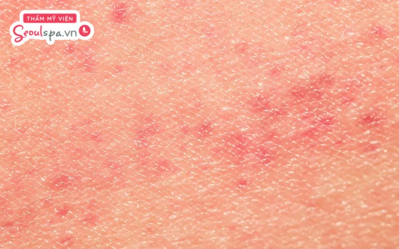 Tình trạng kích ứng và đỏ rát có thể là triệu chứng da bị tổn thương khi tiếp xúc với nhiệt độ cao trong quá trình triệt