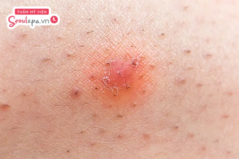 Lông mọc ngược là một trong những tác hại phổ biến và khá thường gặp khi triệt lông vĩnh viễn sai cách