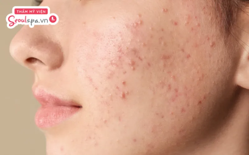 Thực hiện chăm sóc da sai cách sau khi triệt lông mặt là một trong những nguyên nhân phổ biến khiến triệt lông bị nổi mụn