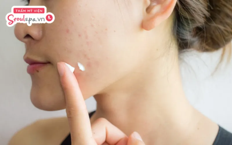 Bôi thoa kem dưỡng da phục hồi chuyên sâu với thành phần lành tính là cách thúc đẩy quá trình tái tạo da và giảm mụn hiệu quả