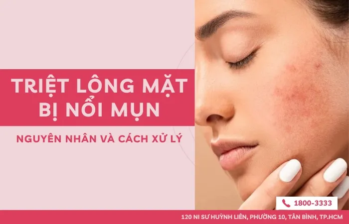 Triệt lông mặt bị nổi mụn - Nguyên nhân và cách xử lý