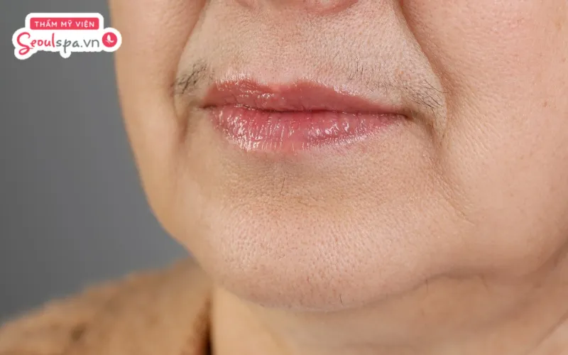 Rối loạn tuyến thượng thận sẽ kích thích hormone androgen phát triển mạnh hơn và khiến lông phát triển mạnh