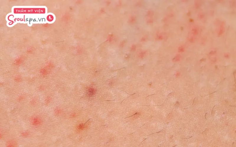 Làn da dễ xuất hiện nguy cơ viêm nhiễm và viêm nang lông khi thực hiện triệt lông trong ngày kinh nguyệt