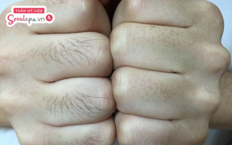Lông mọc ở ngón tay có thể xuất phát bởi nhiều nguyên nhân khác nhau liên quan đến di truyền và nội tiết tố cơ thể