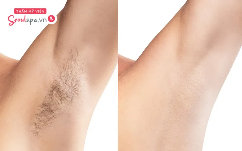 Triệt lông không thể hết chỉ sau 1 lần vì còn tùy thuộc nhiều vào tình trạng nang lông và công nghệ thực hiện