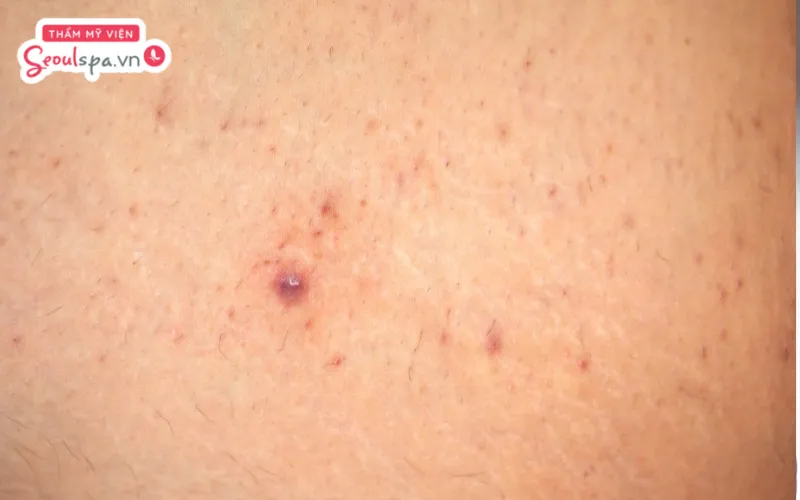 Khi thời tiết khô thoáng và se lạnh, da thường ít tiết mồ hôi hơn giúp ngăn ngừa nguy cơ viêm nang lông hiệu quả